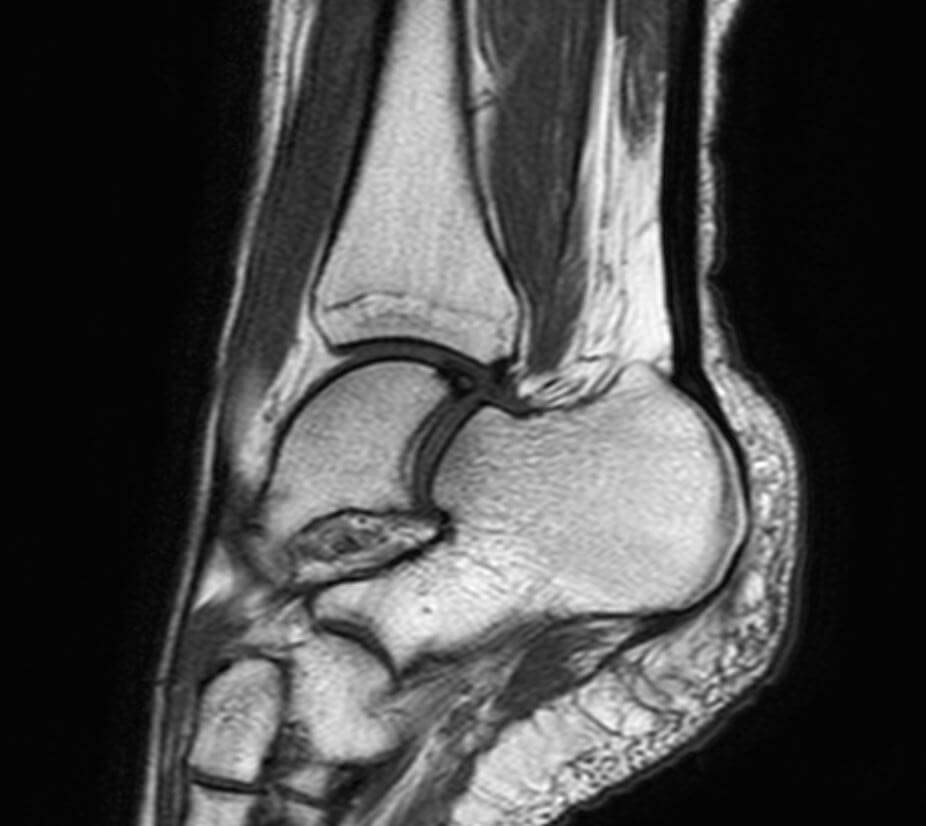 Мрт суставов тела. Магниторезонансная томография коленного сустава. Синовит локтевого сустава мрт. Лигаментит коленного сустава мрт. Гигрома плечевого сустава мрт.